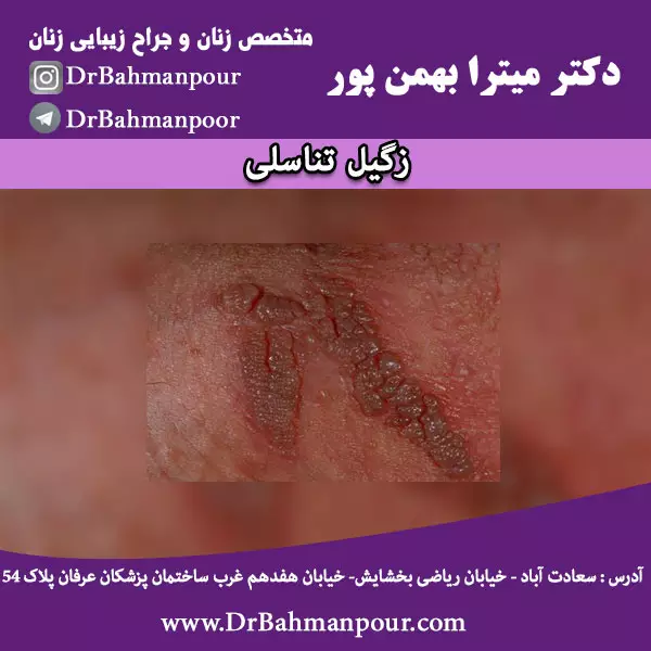 زگیل تناسلی