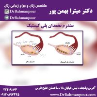 سندرم تخمدان پلی کیستیک