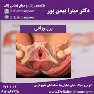 پرینورافی