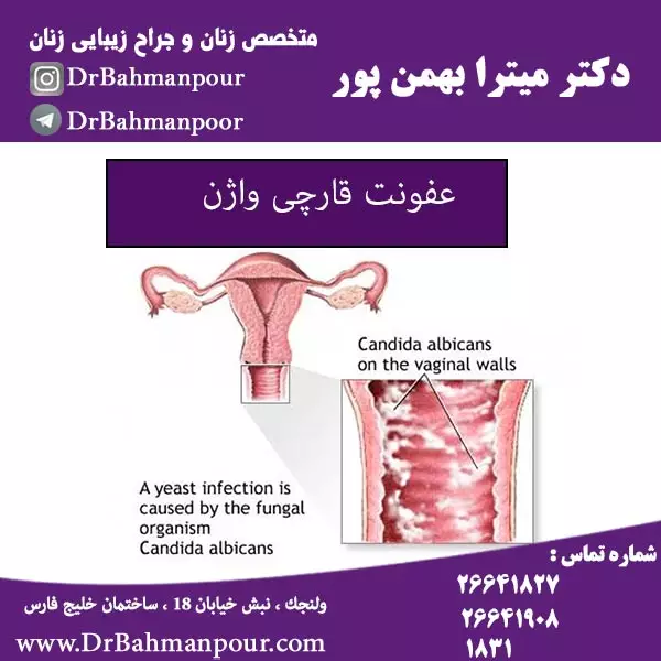 عفونت قارچی واژن