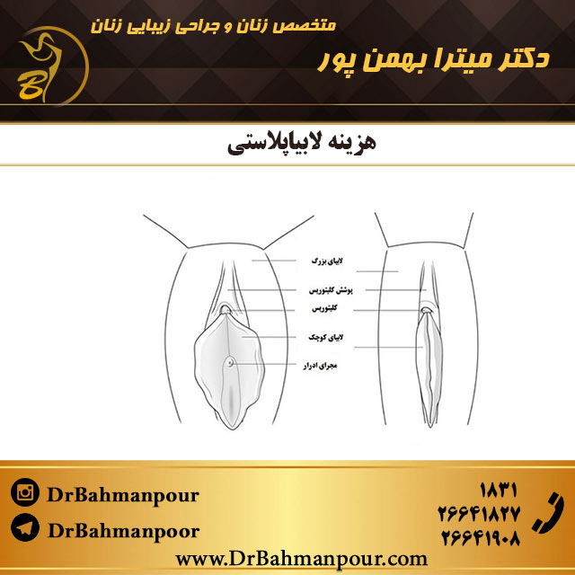هزینه لابیاپلاستی