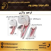 ترمیم واژن