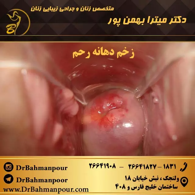 درمان زخم دهانه رحم