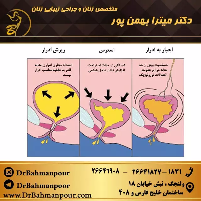 درمان بی اختیاری ادرار در زنان سالمند