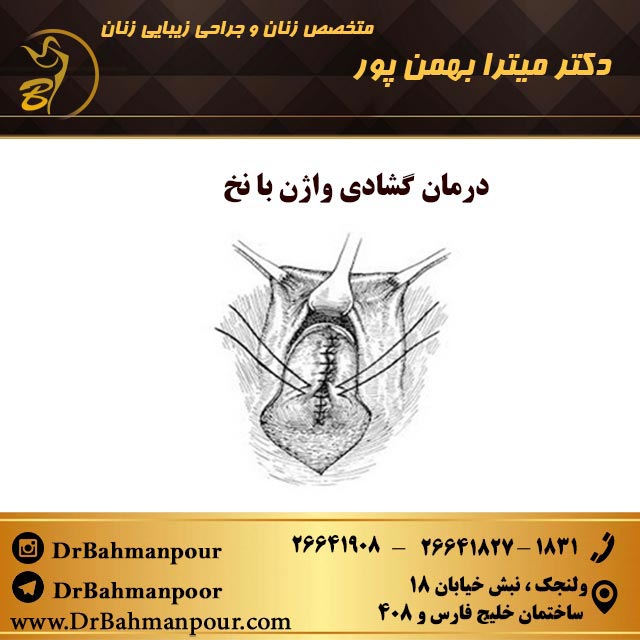 درمان گشادی واژن با نخ درمان گشادی واژن با نخ های واژینال هزینه درمان گشادی واژن با نخ