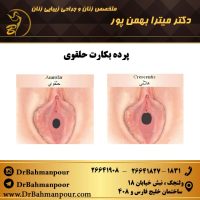 انواع پرده بکارت