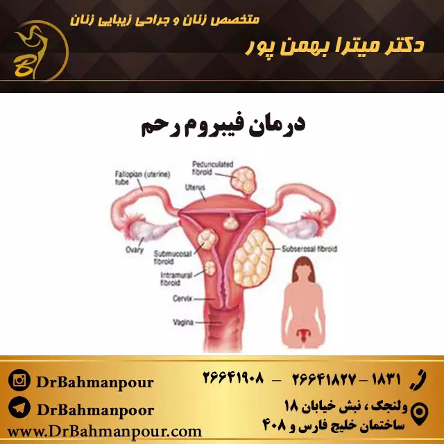 درمان فیبروم رحم