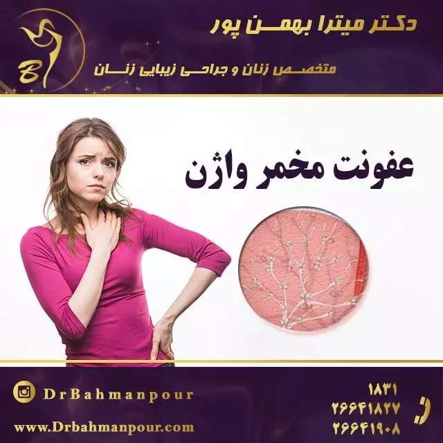 عفونت مخمر واژن