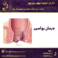 درمان بواسیر