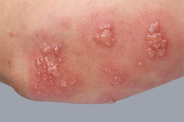 تبخال تناسلی
