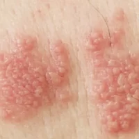 علت بروز تبخال تناسلی