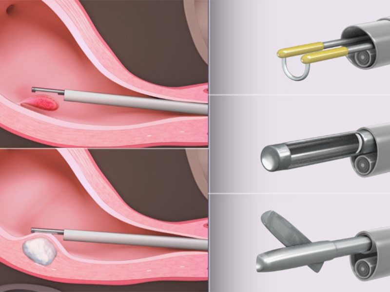 انواع جراحه استئصال الرحم
