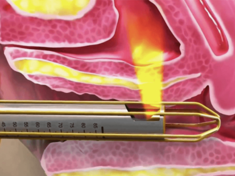 رفع المهبل مع غزل المهبل