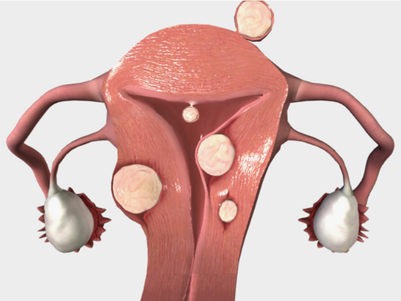 الأورام الليفية الرحمية