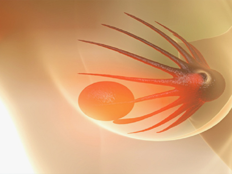 علاج كيسات الثدي