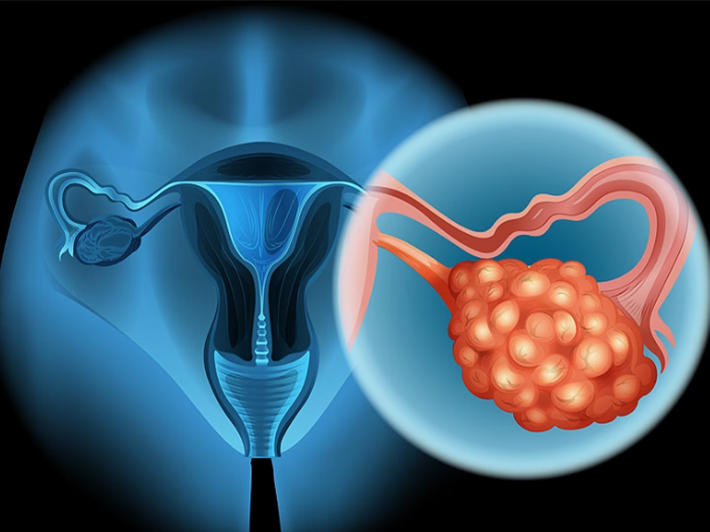 حبوب كسل المبيض