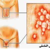 الهربس التناسلي