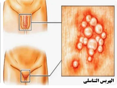 الهربس التناسلي