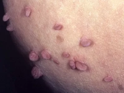 زگیل تناسلی بعد از چند وقت نمایان می شود